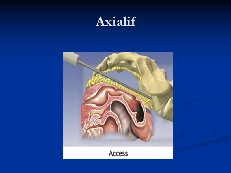 Axialif